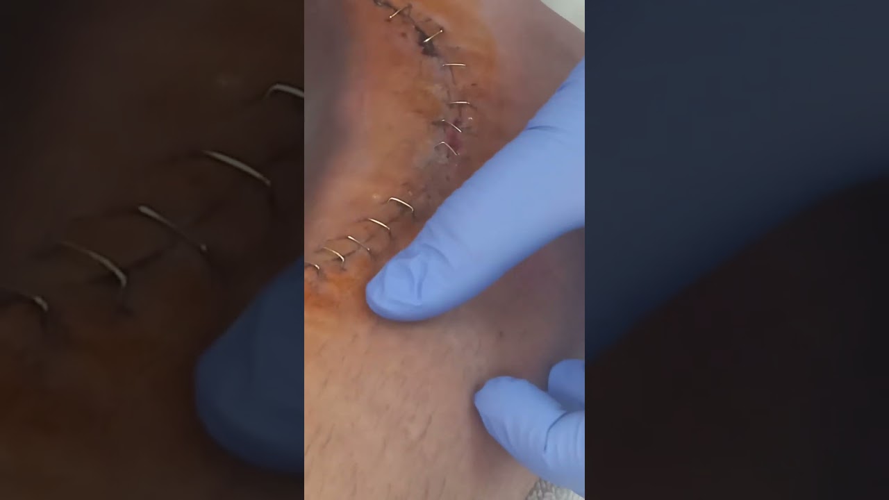 duele quitar las grapas de una herida