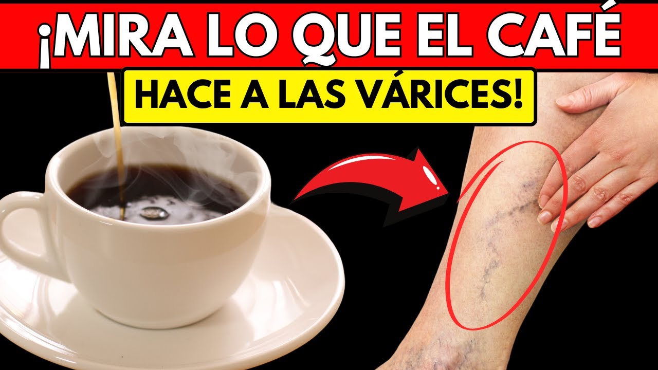 el cafe es malo para las varices