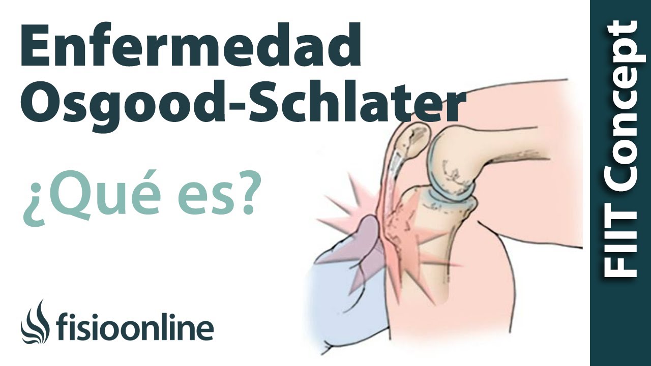 enfermedad de osgood schlatter en adultos