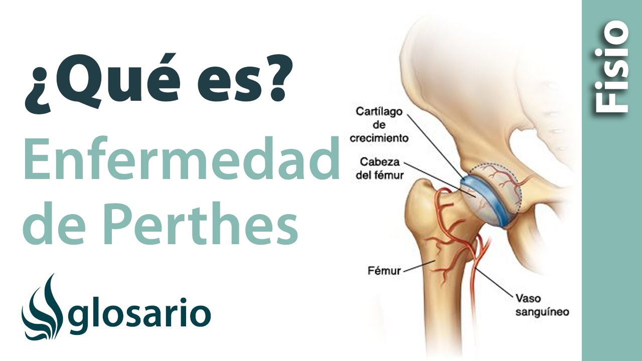 enfermedad de perthes en niños operacion