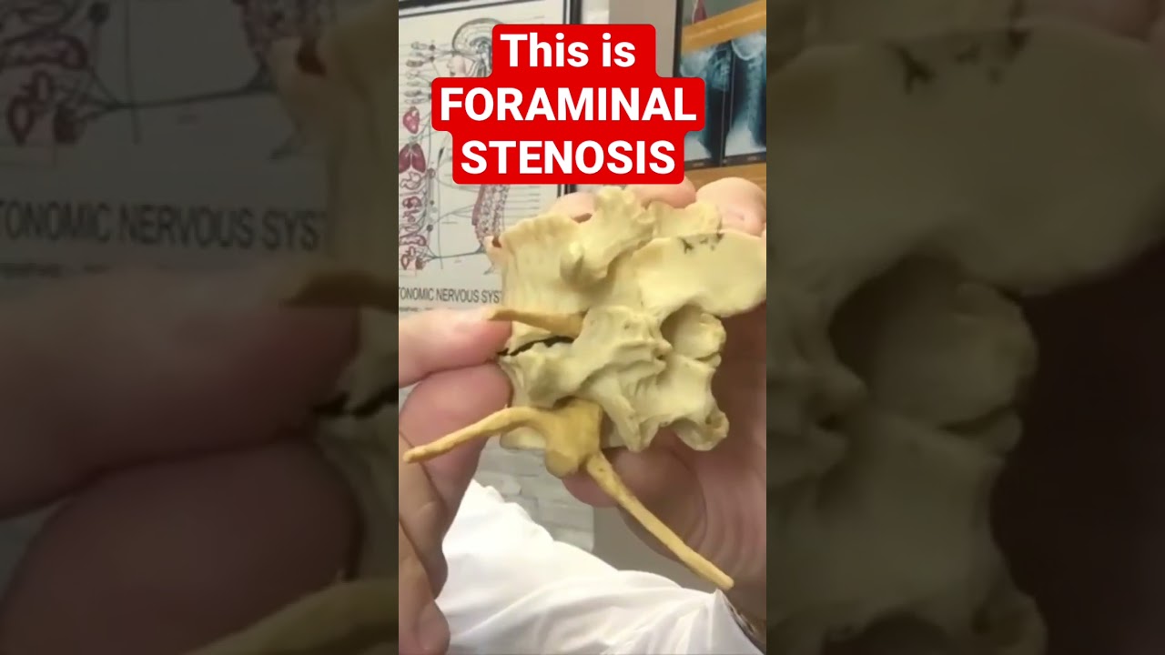 estenosis foraminal bilateral c5 c6 y c6 c7