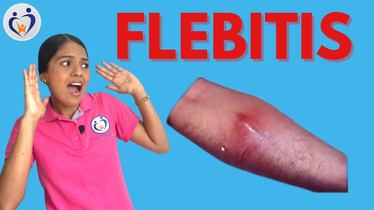 flebitis en brazo por via tratamiento