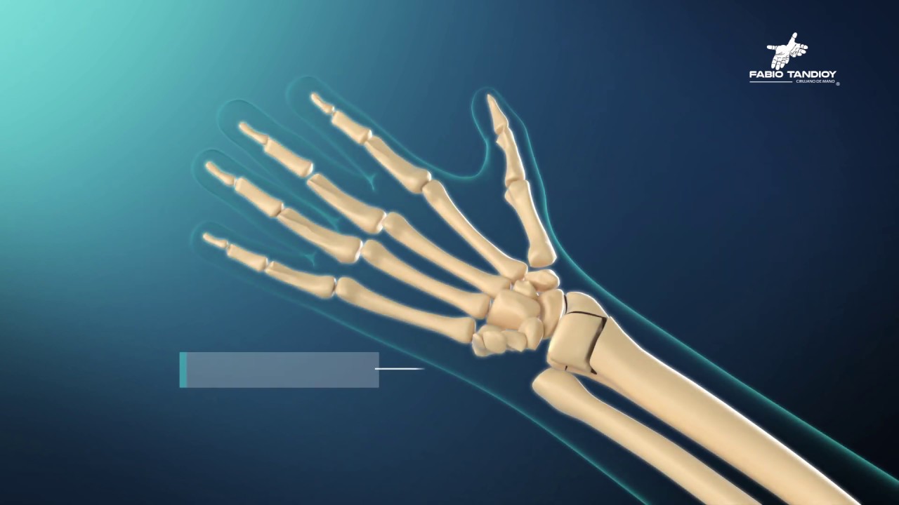 fractura de apofisis estiloides del cubito
