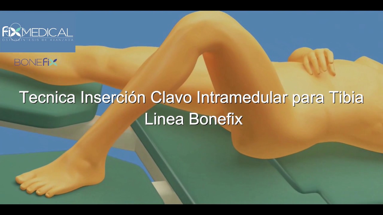 fractura de tibia y perone con clavo intramedular