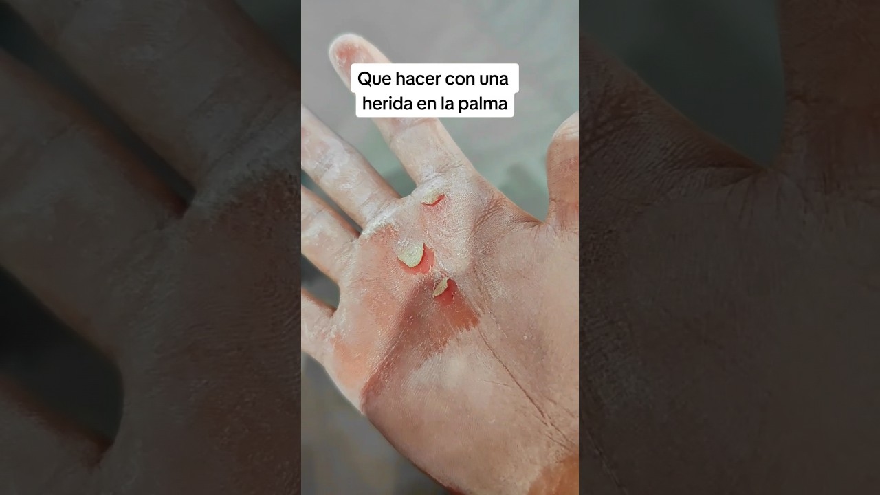 herida en palma de la mano