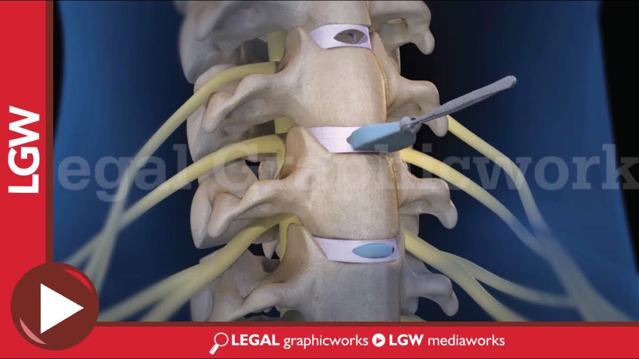 hernias cervicales c3 c4 c5 c6