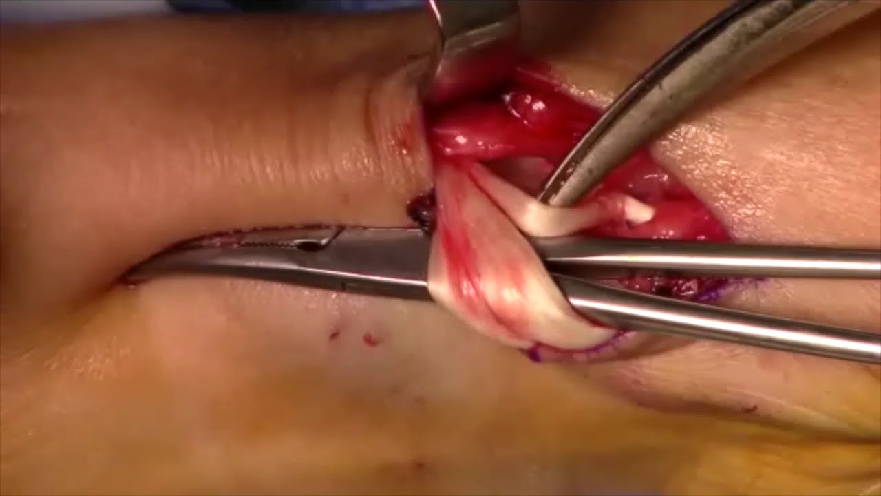 me han operado de tendinitis de quervain