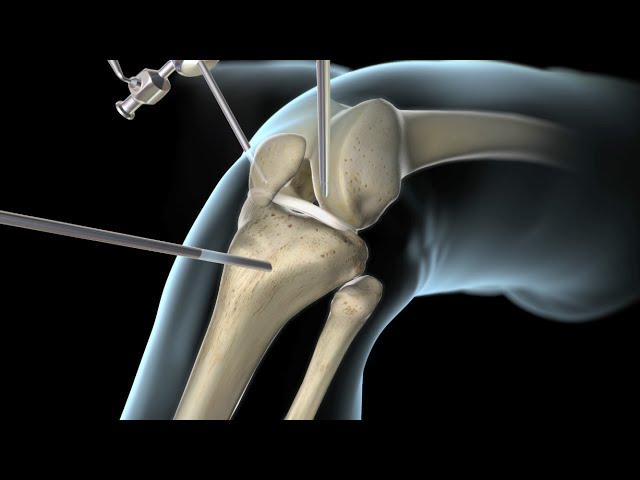operacion de rotura de ligamentos cruzados
