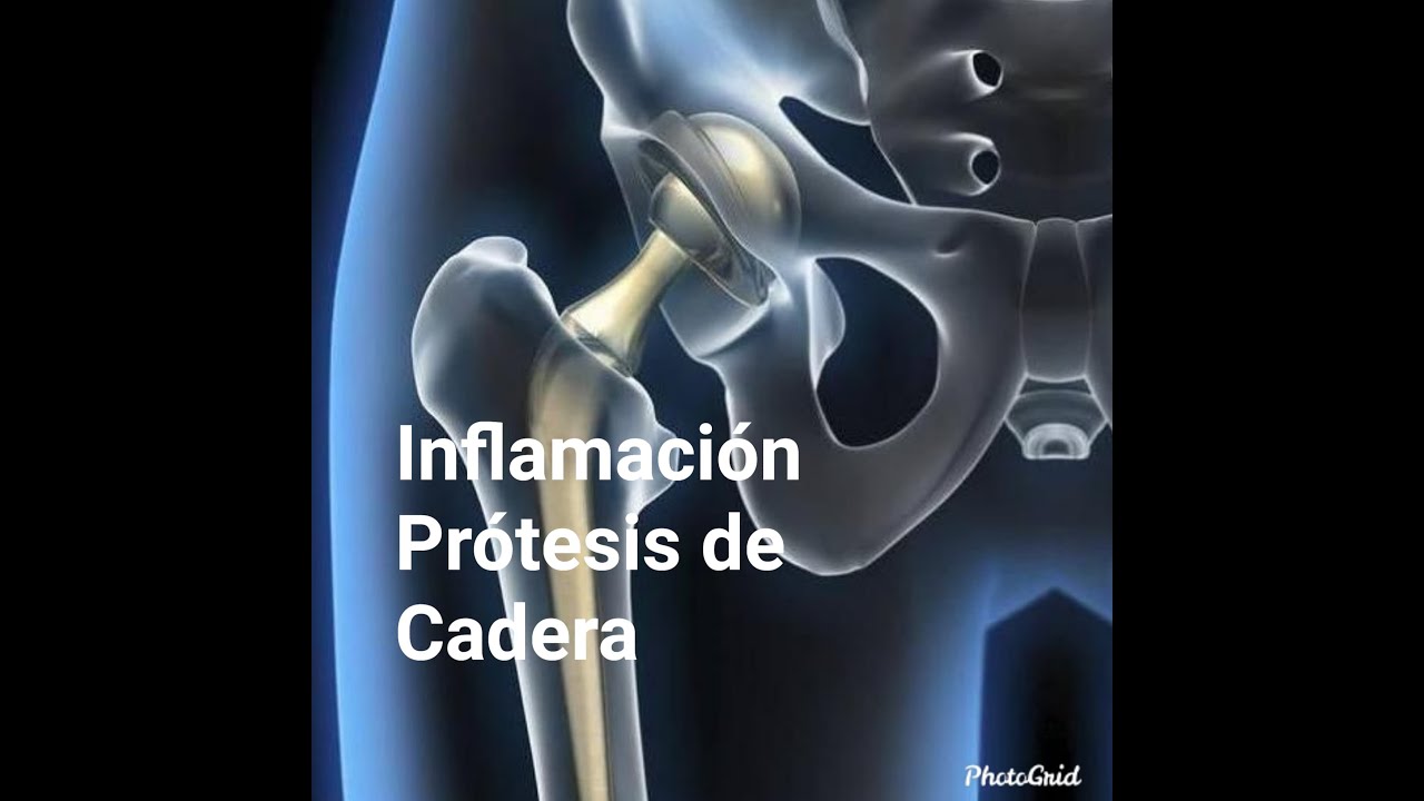 porque se inflama la pierna despues de operacion de cadera