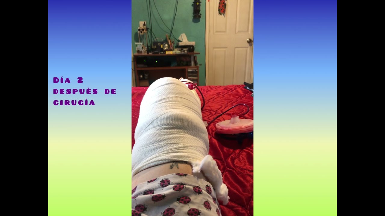 tiempo de recuperación de una artrolisis