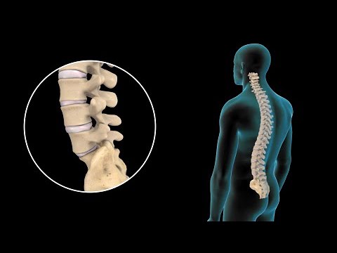 una caida puede provocar una hernia de disco
