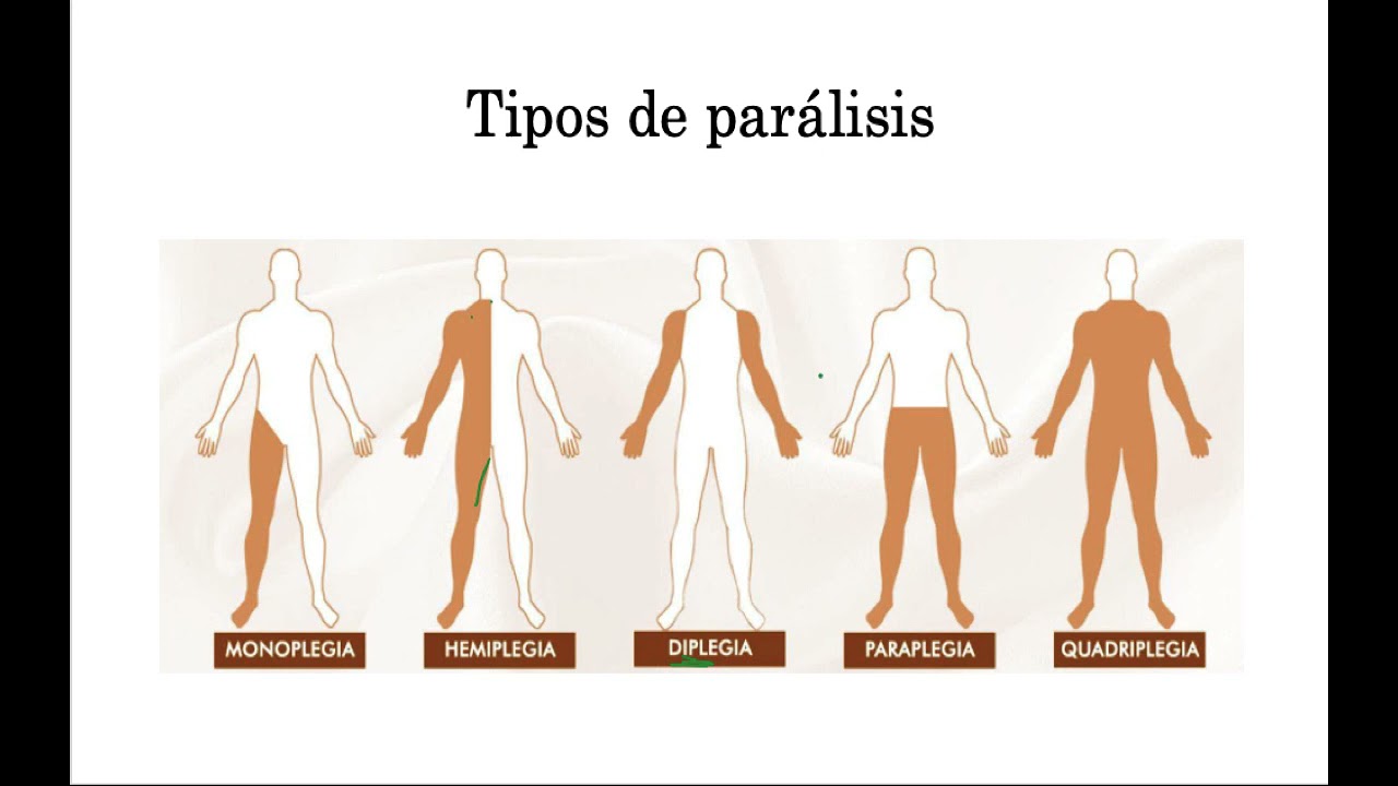 clasificacion topografica de la paralisis cerebral