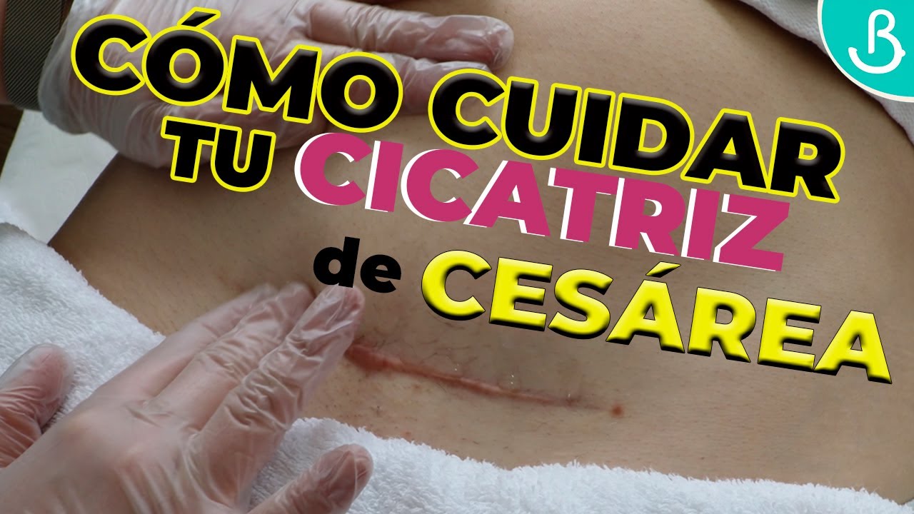como cuidar la cicatriz de una cesarea