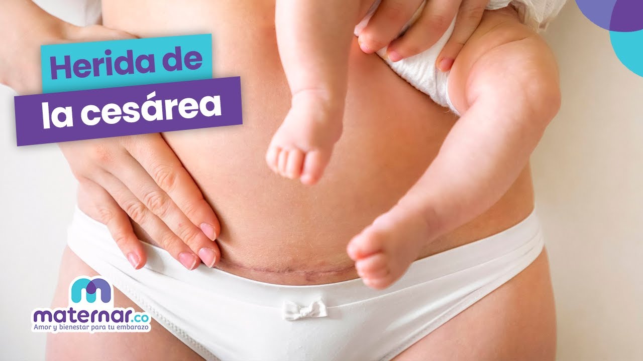 como cuidar la herida de una cesarea