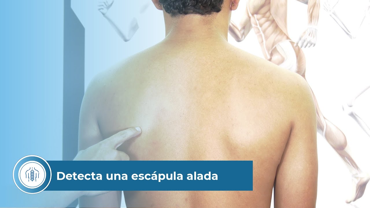 como saber si tengo escapula alada