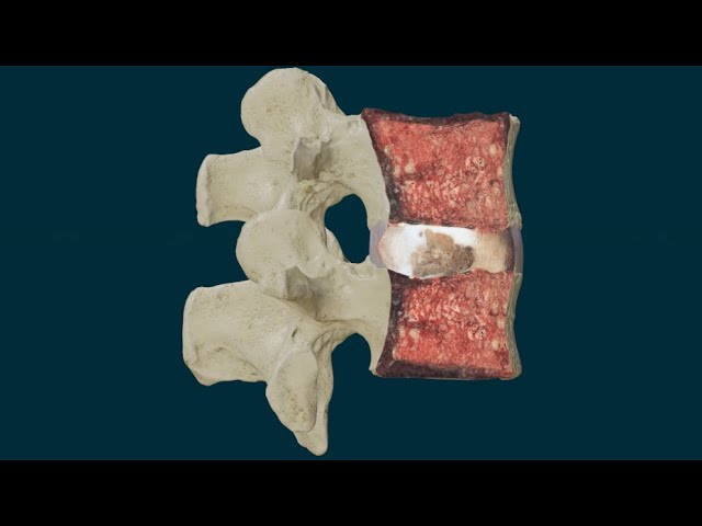 de que estan hechos los discos intervertebrales