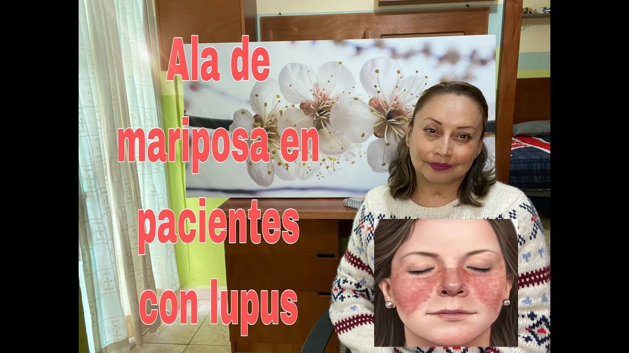 eritema malar en alas de mariposa