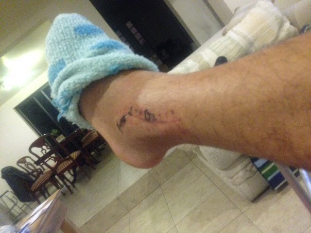 fractura de tobillo tibia y perone