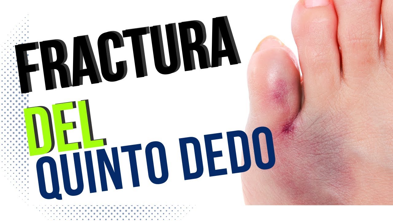 golpe en el dedo pequeño del pie