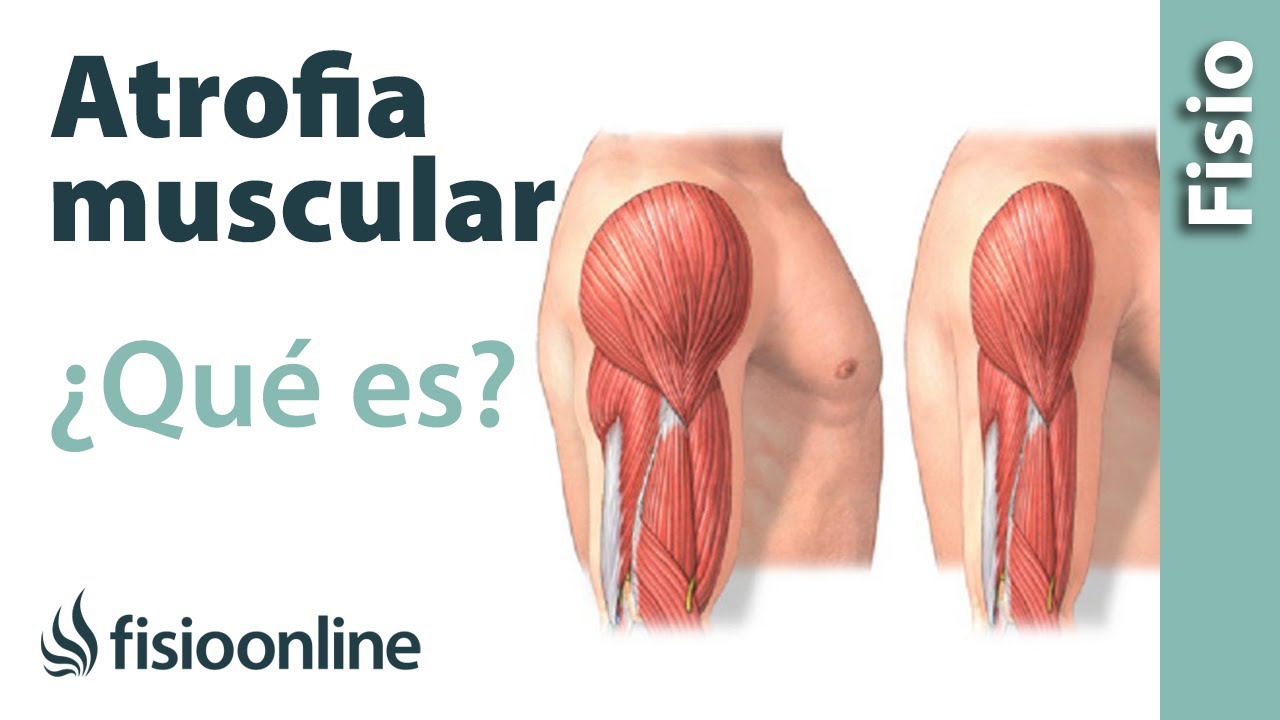 la atrofia muscular es un proceso irreversible