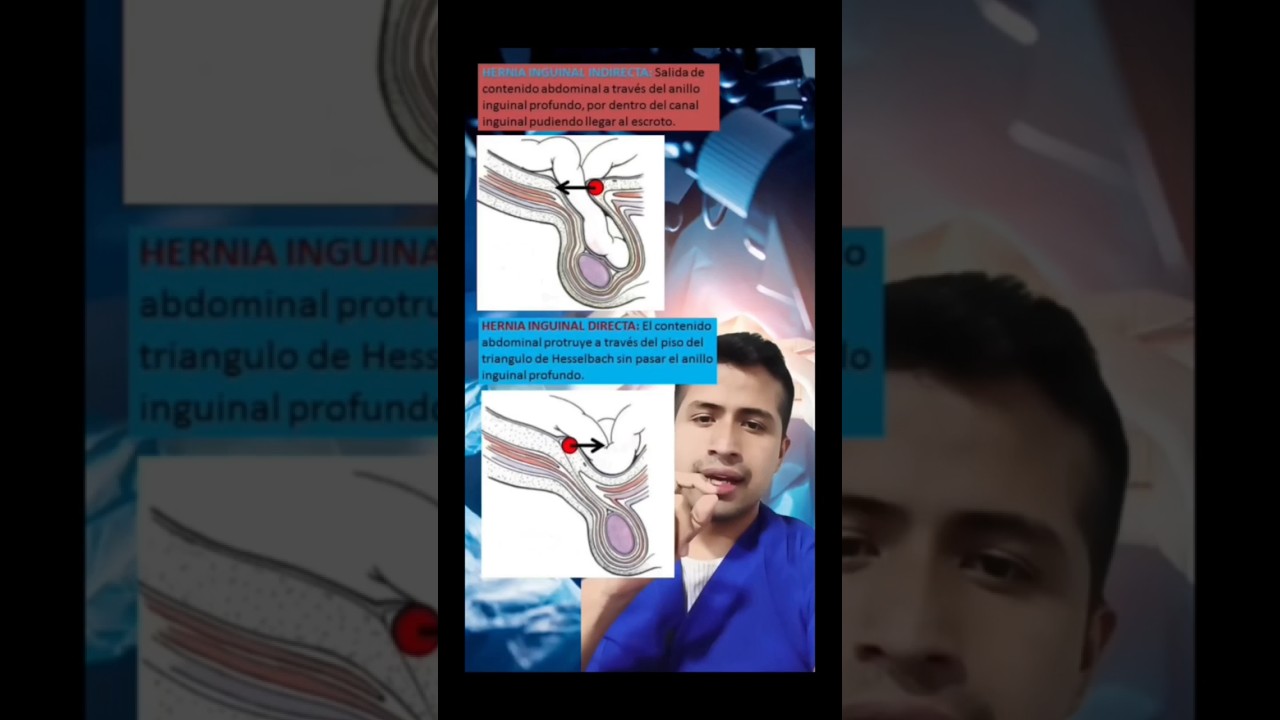 qué diferencia hay entre una hernia inguinal directa e indirecta