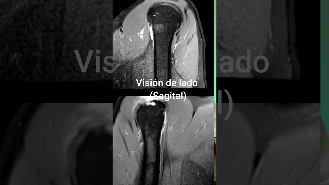 radiografia de hombro derecho con tendinitis