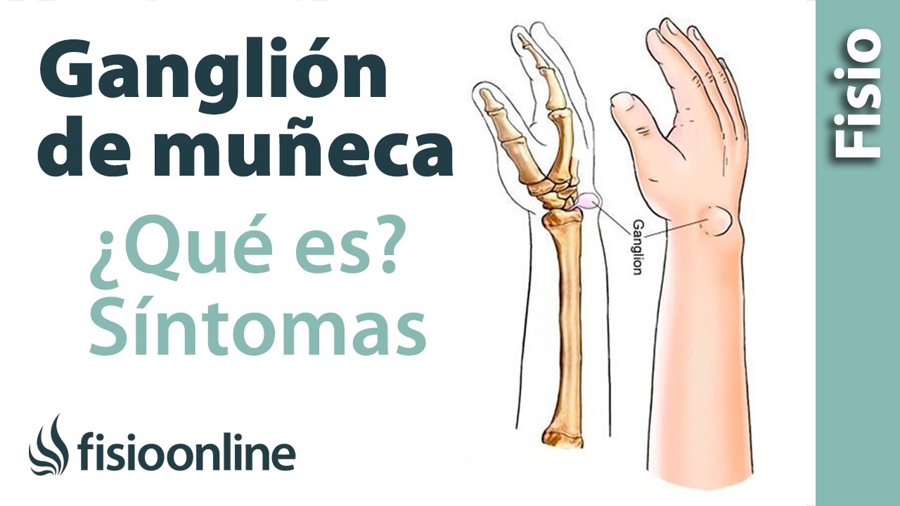 bulto en la muñeca con dolor