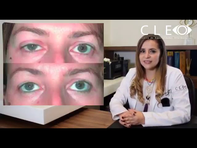 causas de ptosis palpebral unilateral en adultos