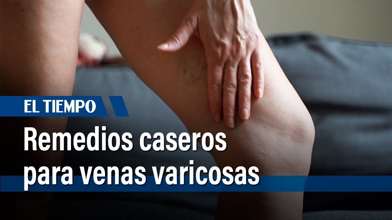 como aliviar el dolor de varices internas