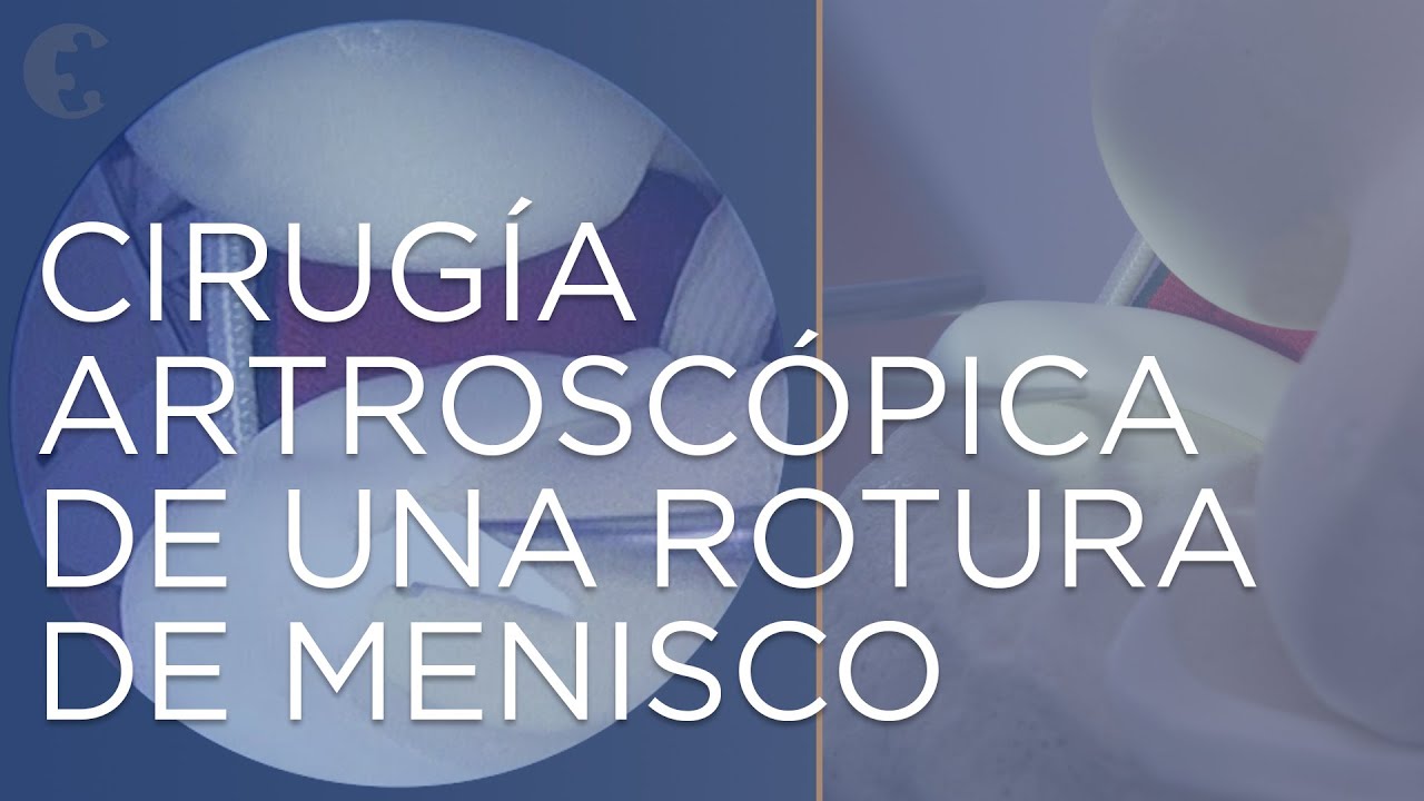 como se llama la cirugia de meniscos