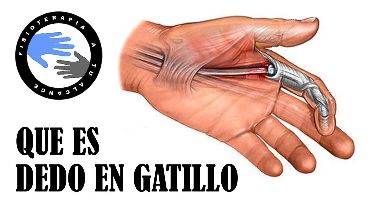 dedo de resorte causas y sintomas