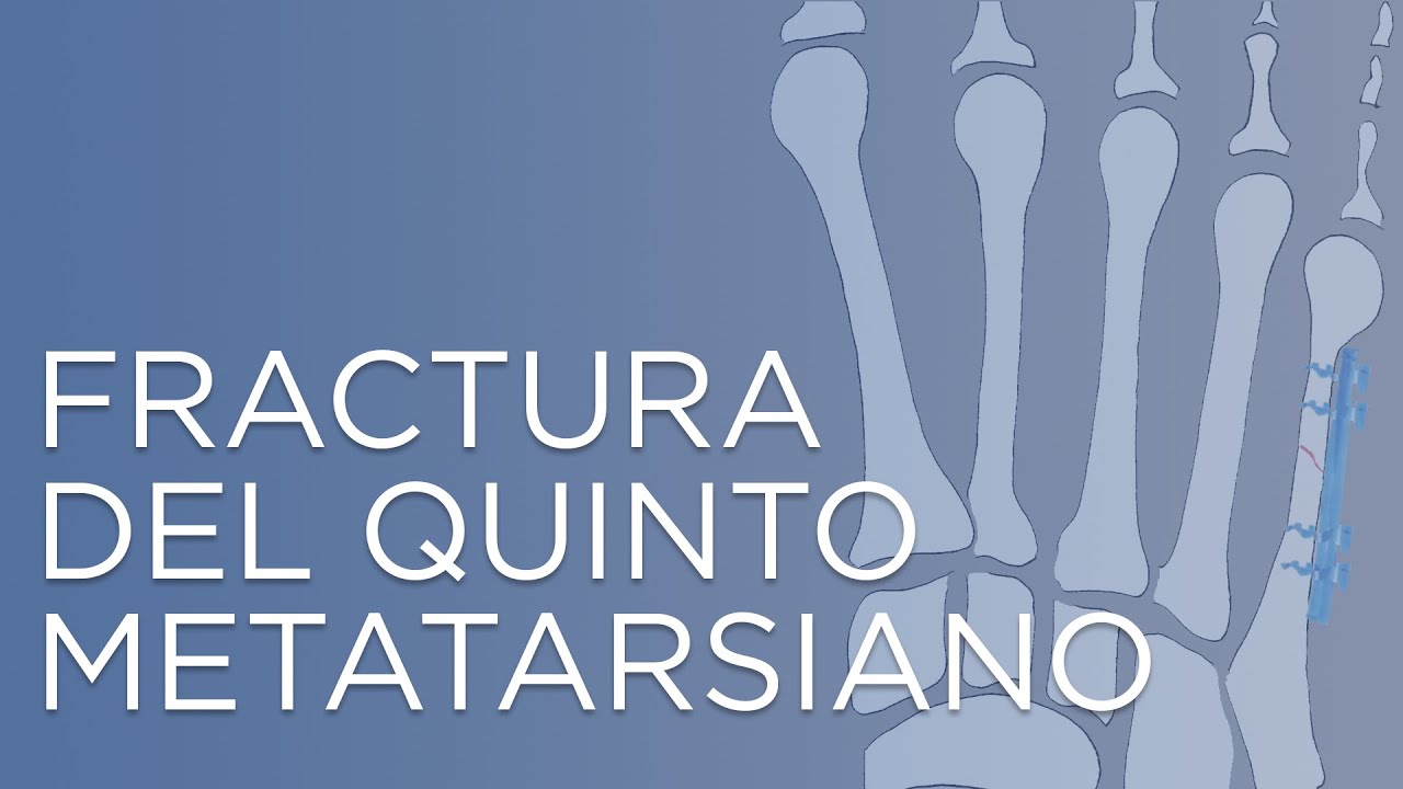 dolor despues de fractura del quinto metatarsiano