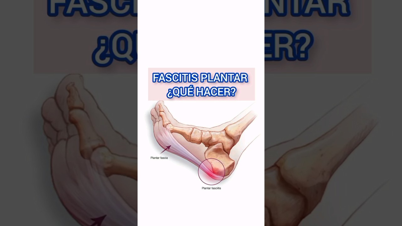 es bueno andar de puntillas para la fascitis plantar