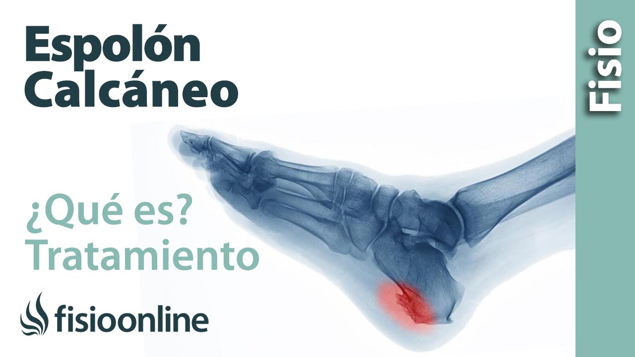 espuela de hueso en el talon