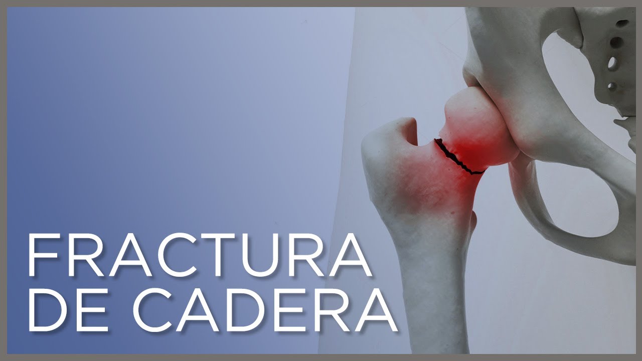 fractura de femur y cadera en ancianos