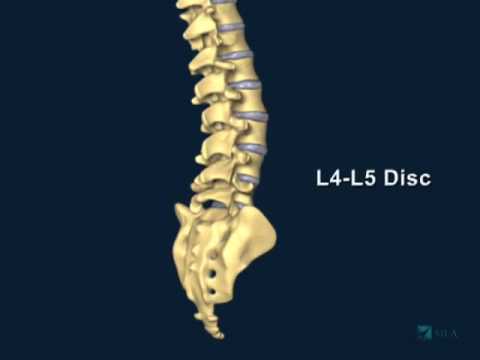 hernia discal lumbar l4 l5 y l5 s1
