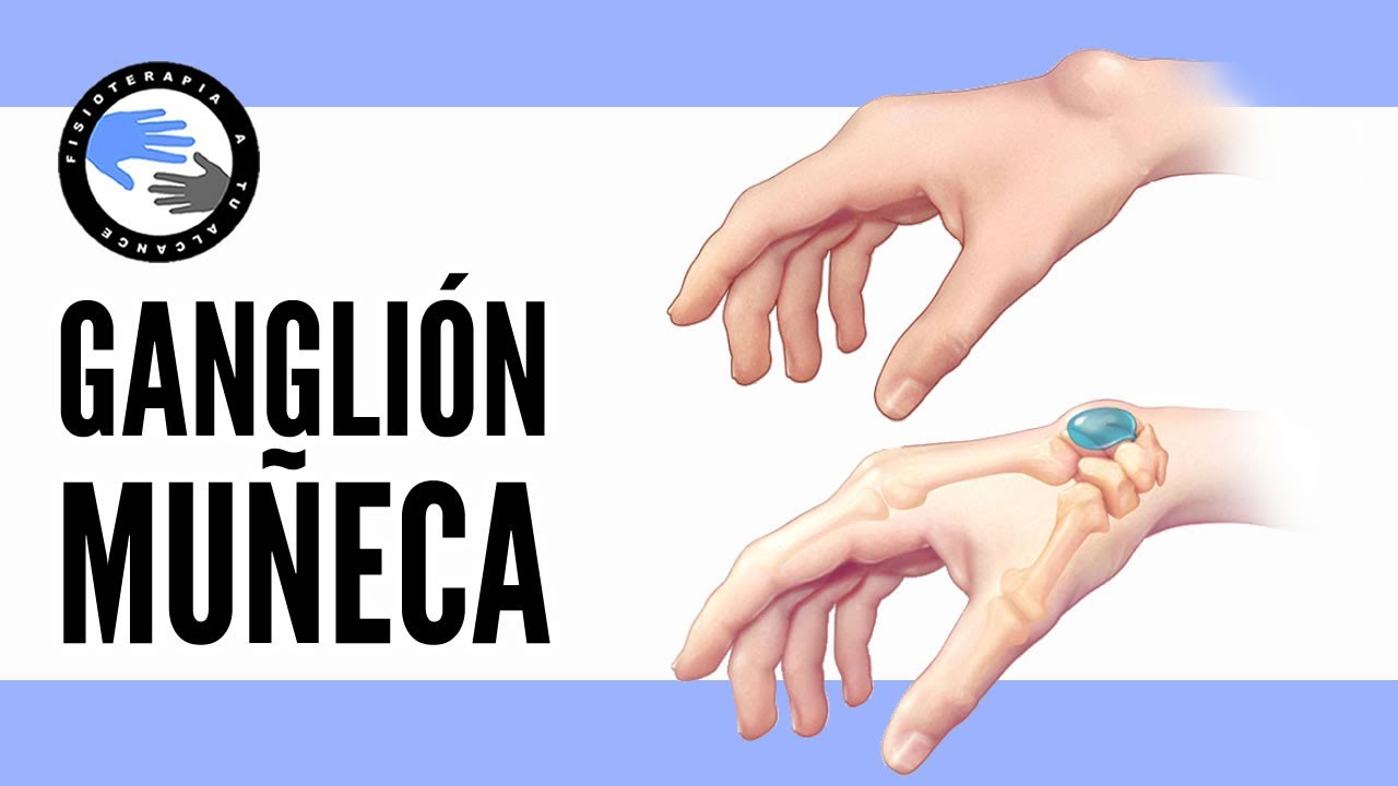 hernia en la muñeca dela mano