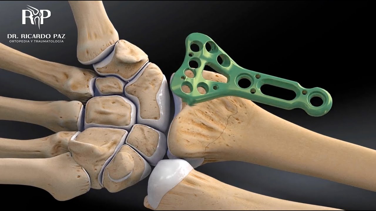 rotura del radio de la mano