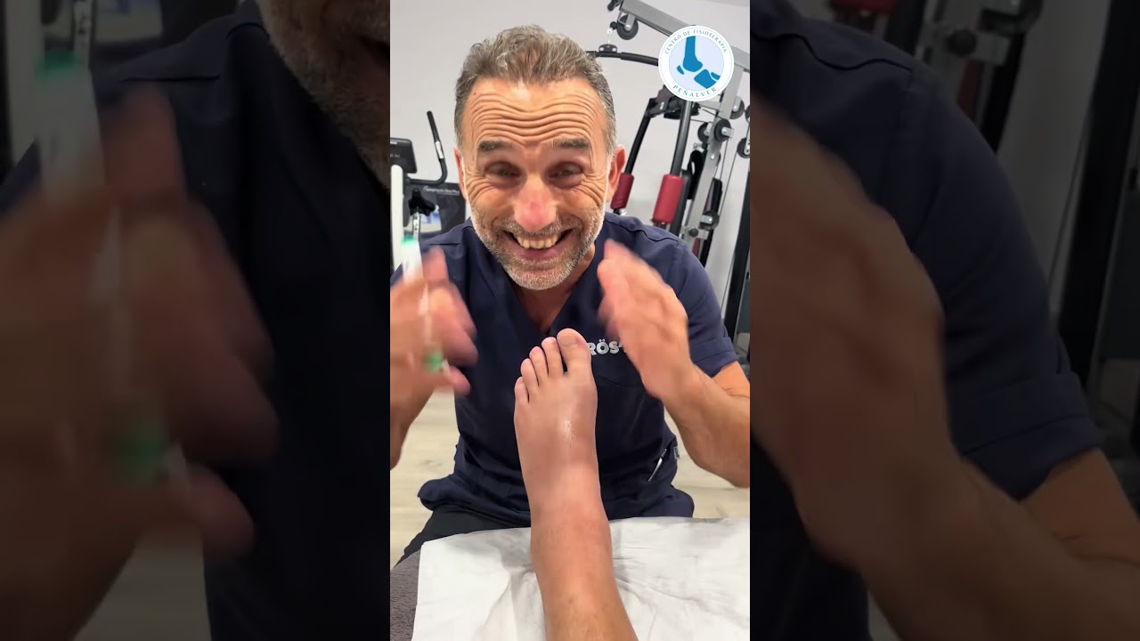 se puede caminar con el astragalo roto