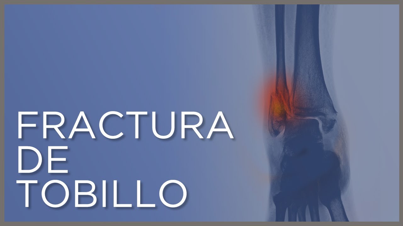 tiempo de baja por fractura de tobillo