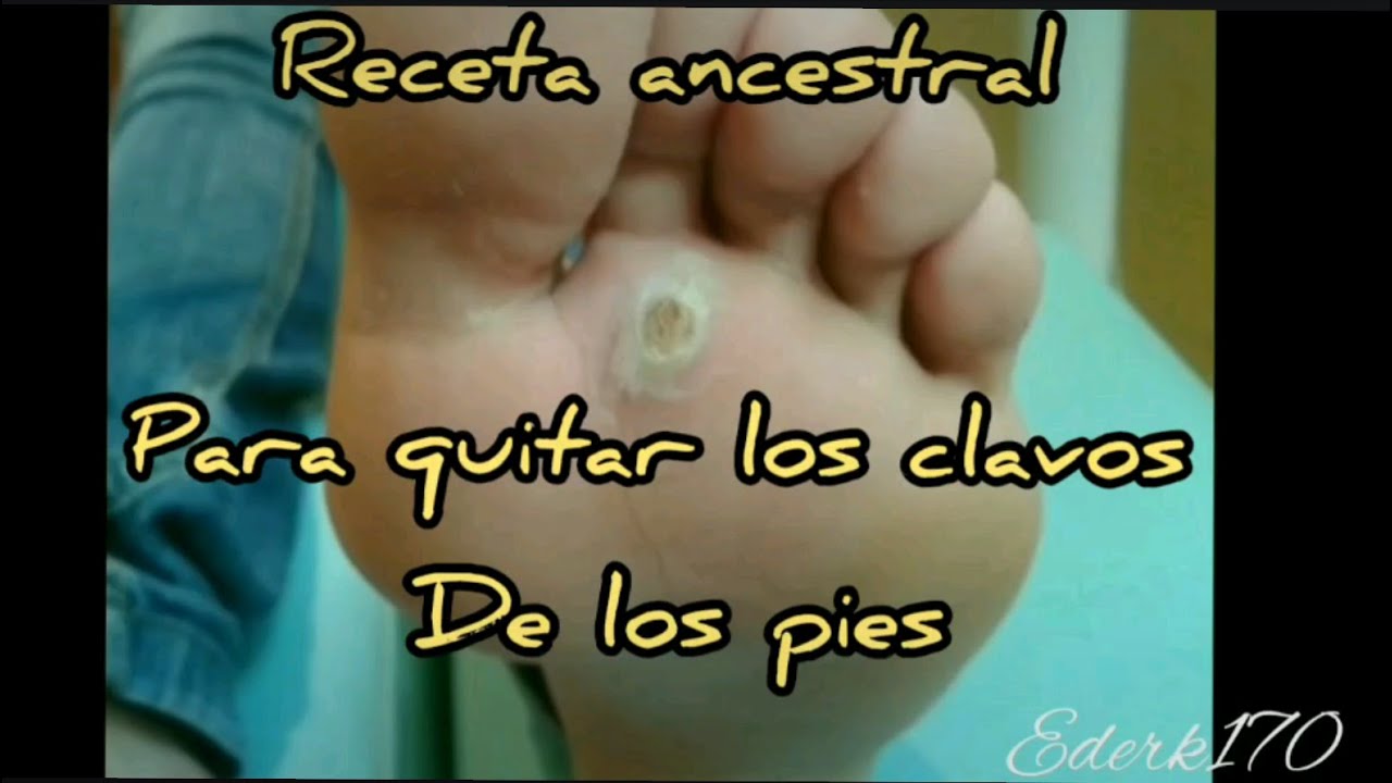 clavos en la planta del pie
