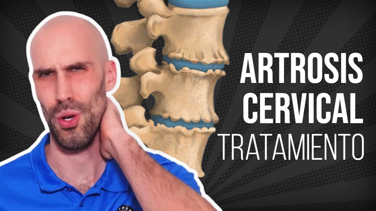 cómo aliviar los dolores de la artrosis cervical