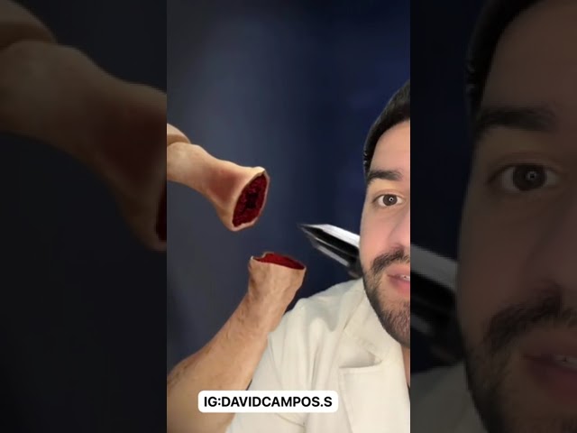 dedo en garra y dedo en martillo