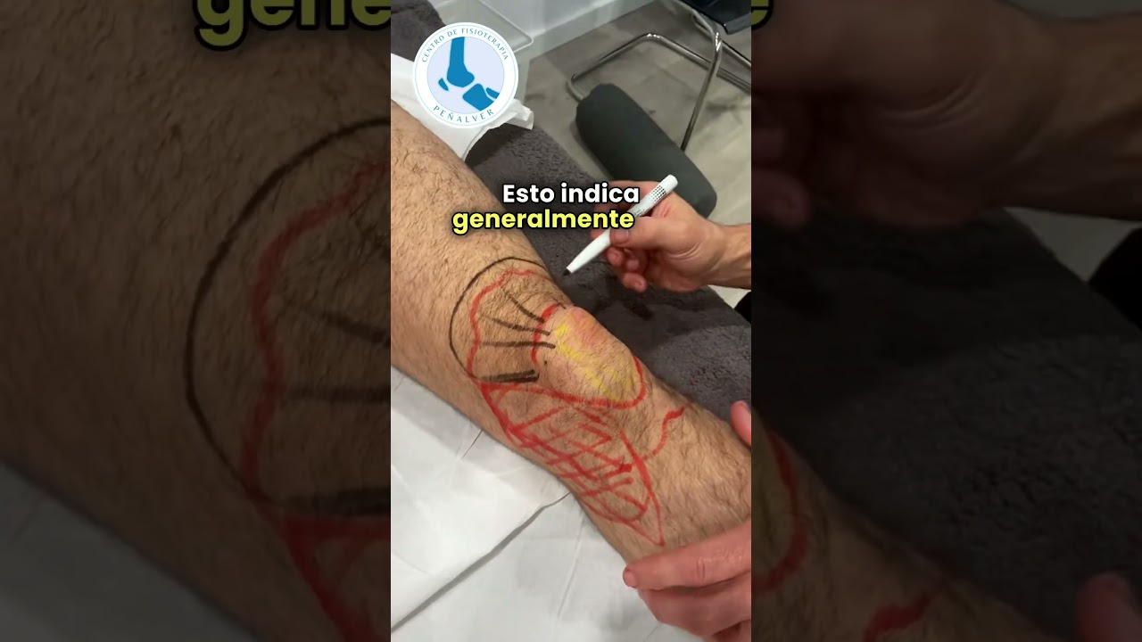 golpe en la rodilla y bulto