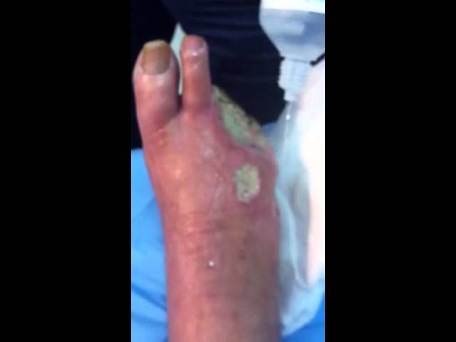 heridas en los pies que no sanan