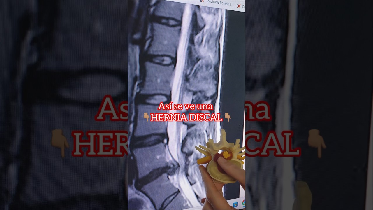 se ve una hernia en una radiografia