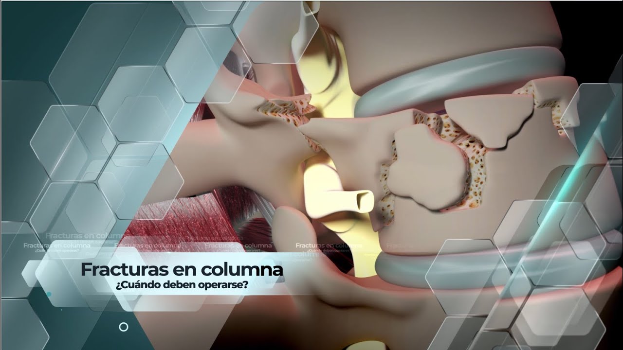 secuelas de fractura de vertebra lumbar