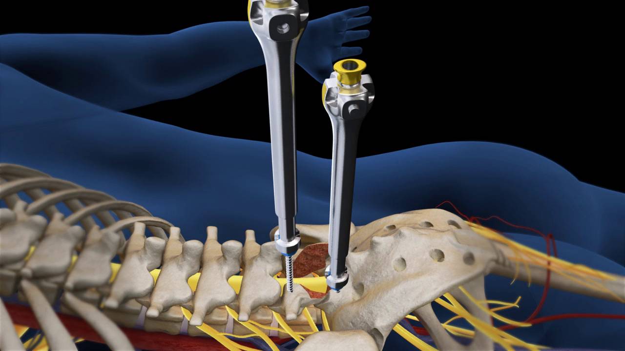 tac columna lumbar l2 a s1